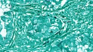 STAT Health News: lung cancer, Florida, Trump, FDA, pig kidneys