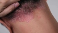 SALUD. La dermatitis atópica: cuando la picazón persistente impacta en la calidad de vida