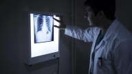 Más de 18 millones de personas morirán por cáncer en 2050, un 75% más que ahora