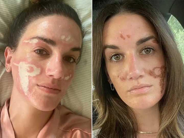 Una mujer se viralizó en TikTok por contar cómo una cosmetóloga de famosos la desfiguró permanentemente: "Me dejó cicatrices de por vida"