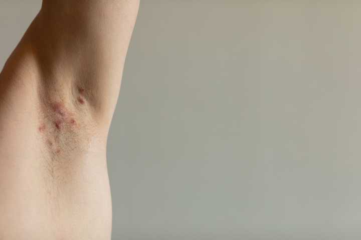 Research Shows Hidradenitis Suppurativa Impacts 1% Globally, With Women More Affected