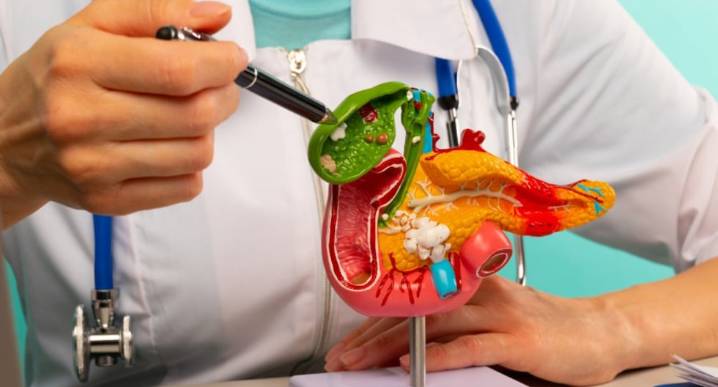 Comer para vivir: Qué son los cálculos en la vesícula y cómo evitarlos