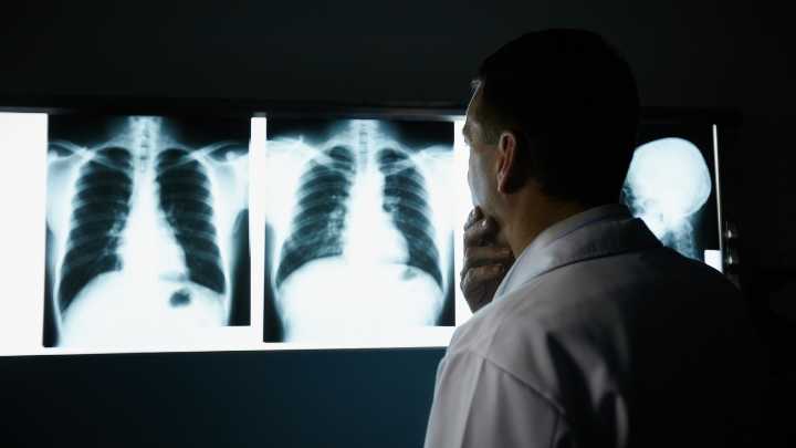 El cáncer de pulmón, de letal a ¿cerca de cronificarse?