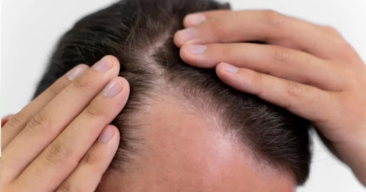 ¿A qué edad empieza la caída del pelo en hombres? Esto dice la ciencia sobre la calvicie