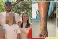 ‘Healthy’ dad left moments from death after ankle blister morphed into flesh-eating infection that shut down his organs