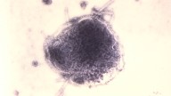 Los Angeles child dies from rare measles complication years after recovery