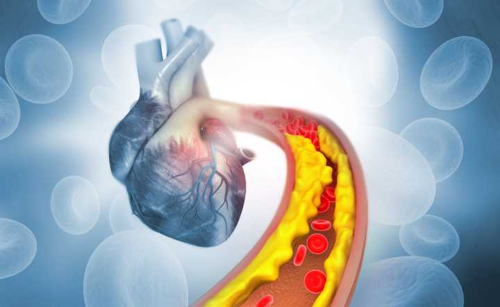 FDA Approves Extended Indication for Evkeeza