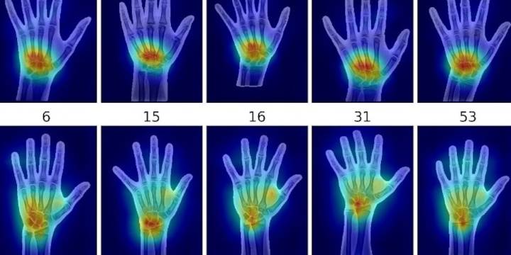 La inteligencia artificial identifica el sexo en radiografías de mano con más del 95% de precisión