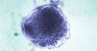 Los Angeles child dies from rare measles complication years after recovery