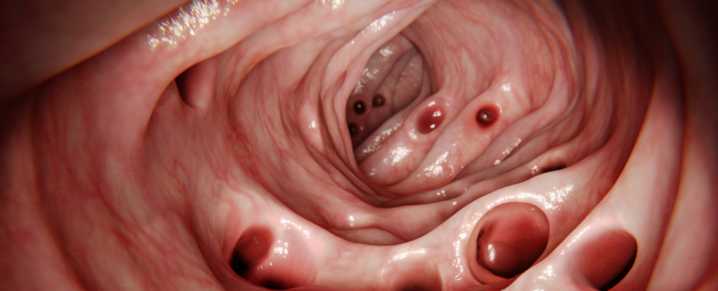 Most People Develop Diverticulosis in Their Gut by Age 80 … So What Is It?