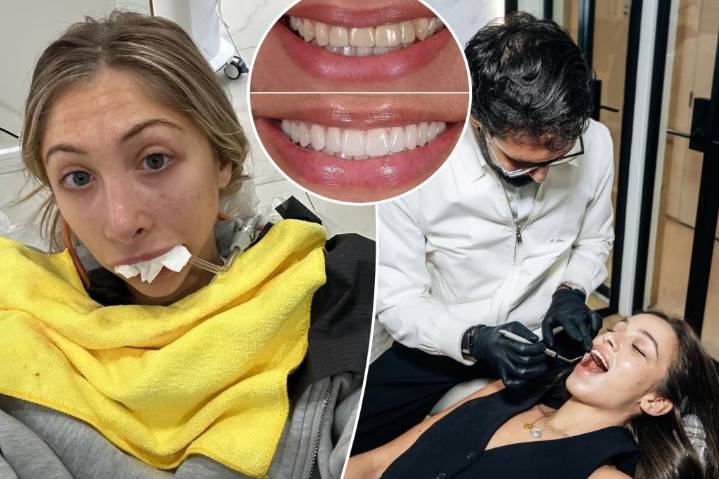 Exclusive | Celebs made veneers a popular post-pandemic cosmetic quick fix — but regret is on the rise: 'My mouth is permanently screwed up'