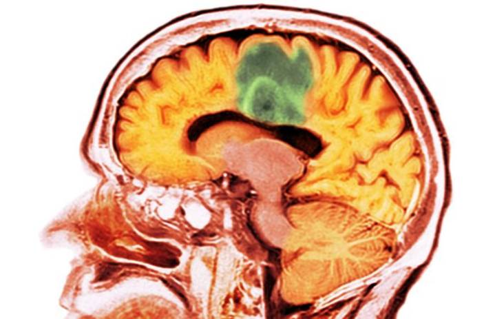 Targeting ADAR1 in Glioblastoma Slows Tumor Growth and Reignites Immune Response