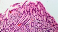 Helicobacter pylori: así son los síntomas de la infección que afecta a la mitad de la población