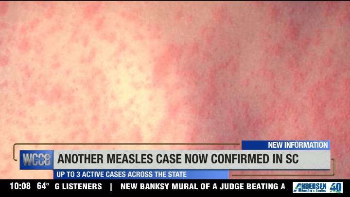Another measles case confirmed in South Carolina
