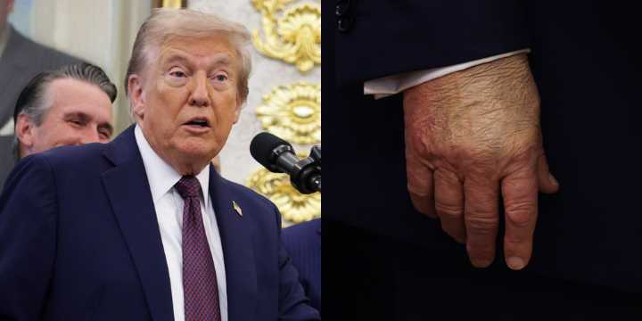 Donald Trump Makes First Official Appearance in Days Amid Health Rumors, Still Wearing Concealer on Hand (Photos) 