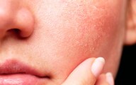 ¿Por qué aparece y cómo se trata la dermatitis atópica? Lo que revelan los expertos en su día mundial