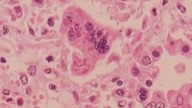 Third case of measles confirmed in South Carolina Upstate in 2025