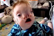 Infant Born with Face in 2 Halves Due for Surgery to 'Button' Him Up