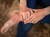 Dermatitis atópica: por qué se detectan cada vez más casos en adultos
