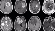 Cuando el cáncer afecta al cerebro: primeros síntomas de alerta, tratamientos y esperanza de vida