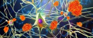 Clinical Trial To Transform Alzheimer's Diagnosis Launched in UK