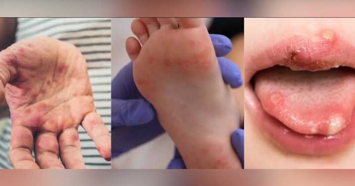 MSCS parents concerned after multiple cases of Hand, Foot and Mouth Disease