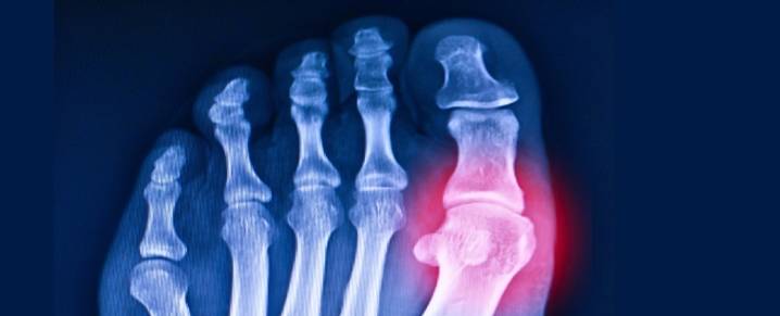Scientists Revive 20-Million-Year-Old Gene to Help Fight Gout