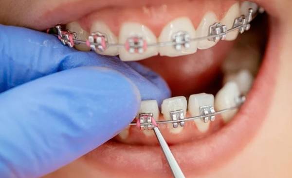 La ANMAT prohibió la venta de brackets falsificados y alertó sobre riesgos para la salud