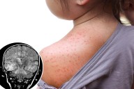 Deadly brain disorder can develop a decade after measles infection