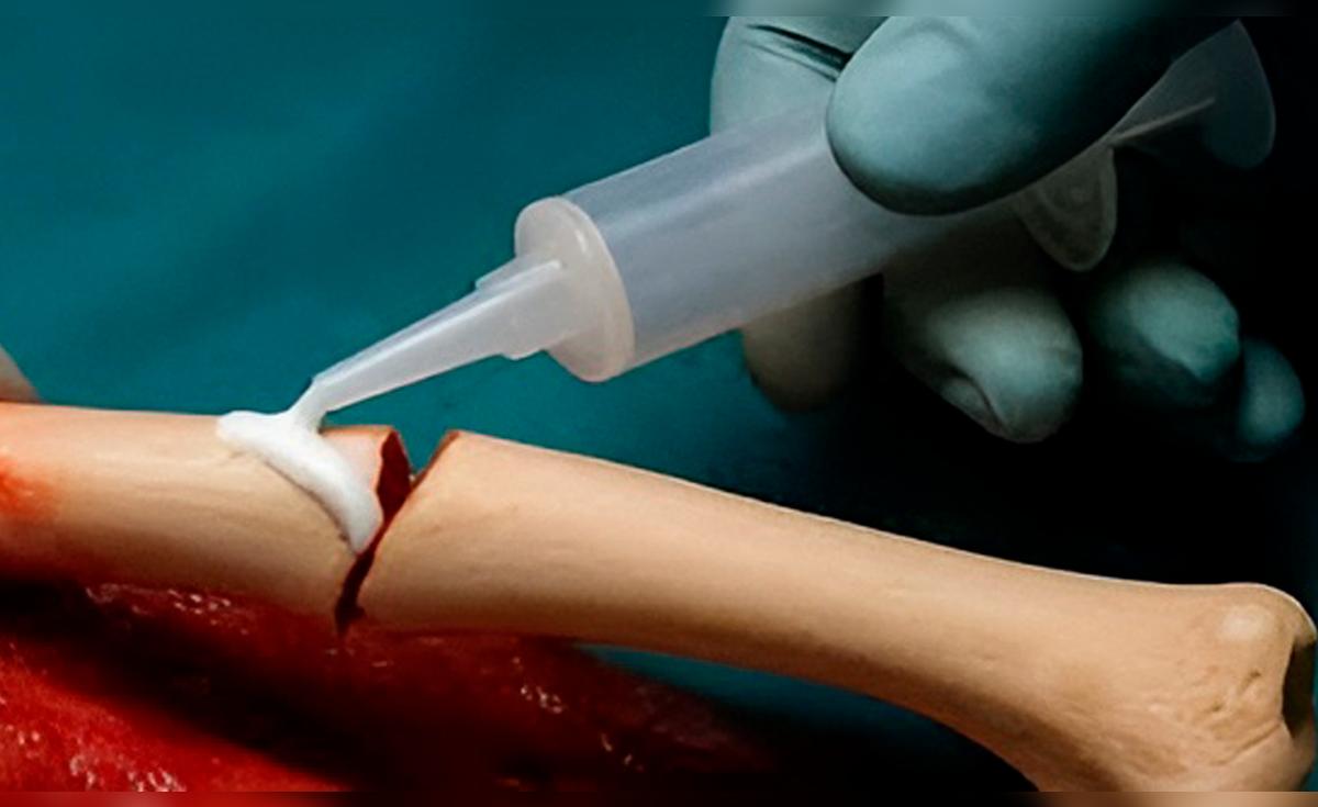 Científicos chinos crean un pegamento para huesos que repara fracturas en solo tres minutos de forma rápida y segura