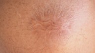 Experimental Cream Could Make 'Permanent' Scars a Thing of the Past