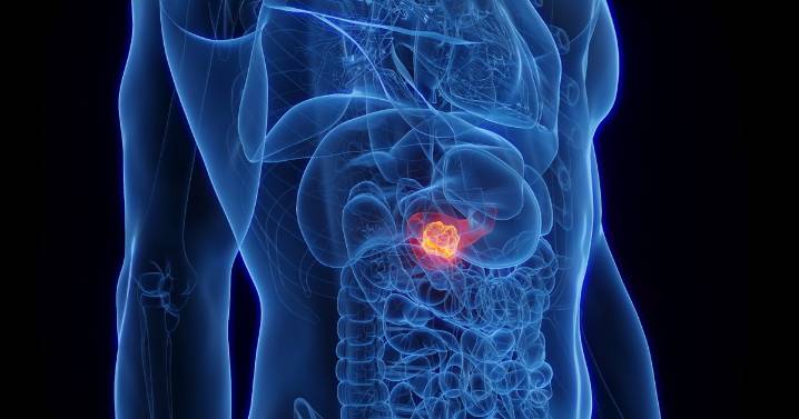 Major cancer breakthrough as lifestyle choice tied with deadly disease