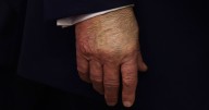Donald Trump Is Getting Better At Covering His Bruises