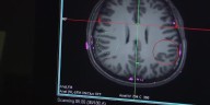 The lasting impact of a concussion