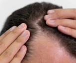 Cinco causas de la caída del cabello y cómo evitarla