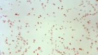 Sexually transmitted disease cases fall, but not syphilis in newborns