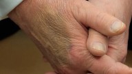 Por qué el visible hematoma en la mano de Donald Trump puede ser el síntoma de algo más grave, según una cirujana vascular