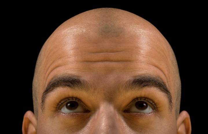 What you eat and drink can contribute to your hair loss