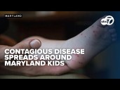 Hand, Mouth and Foot Disease cases rise in Maryland, a Doctor explains impact on kids