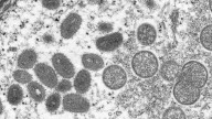 Chicago sees rise in mpox cases in recent months, health officials say