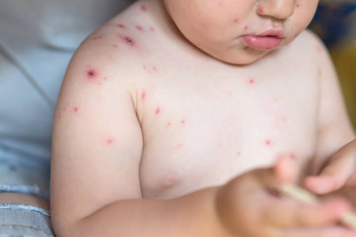 CDC to change measles and chickenpox vaccine due to seizures