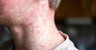 UKHSA issues vaccine health warning to Brits planning holiday in 2025