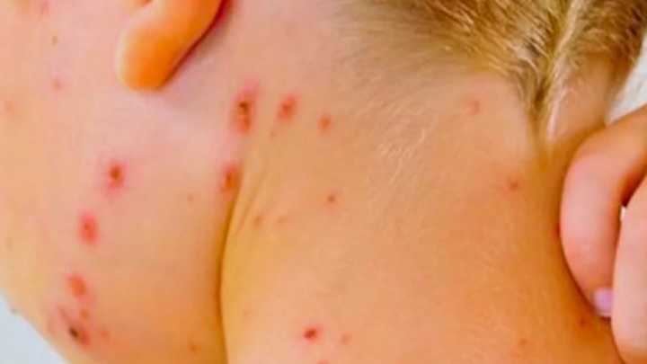 Niño con Sarampión en Jalisco Evoluciona Bien; Caso Está Bajo Control