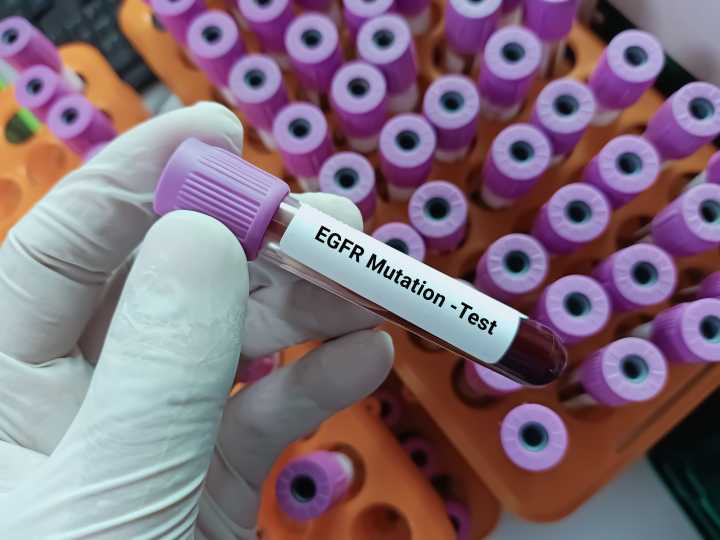 New Pill Offers Hope for Patients With Hard-to-Treat Lung Cancer Mutation