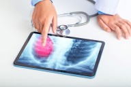 Emphysema on Low-Dose CT Screening Predictive of Mortality Up to 25 Years