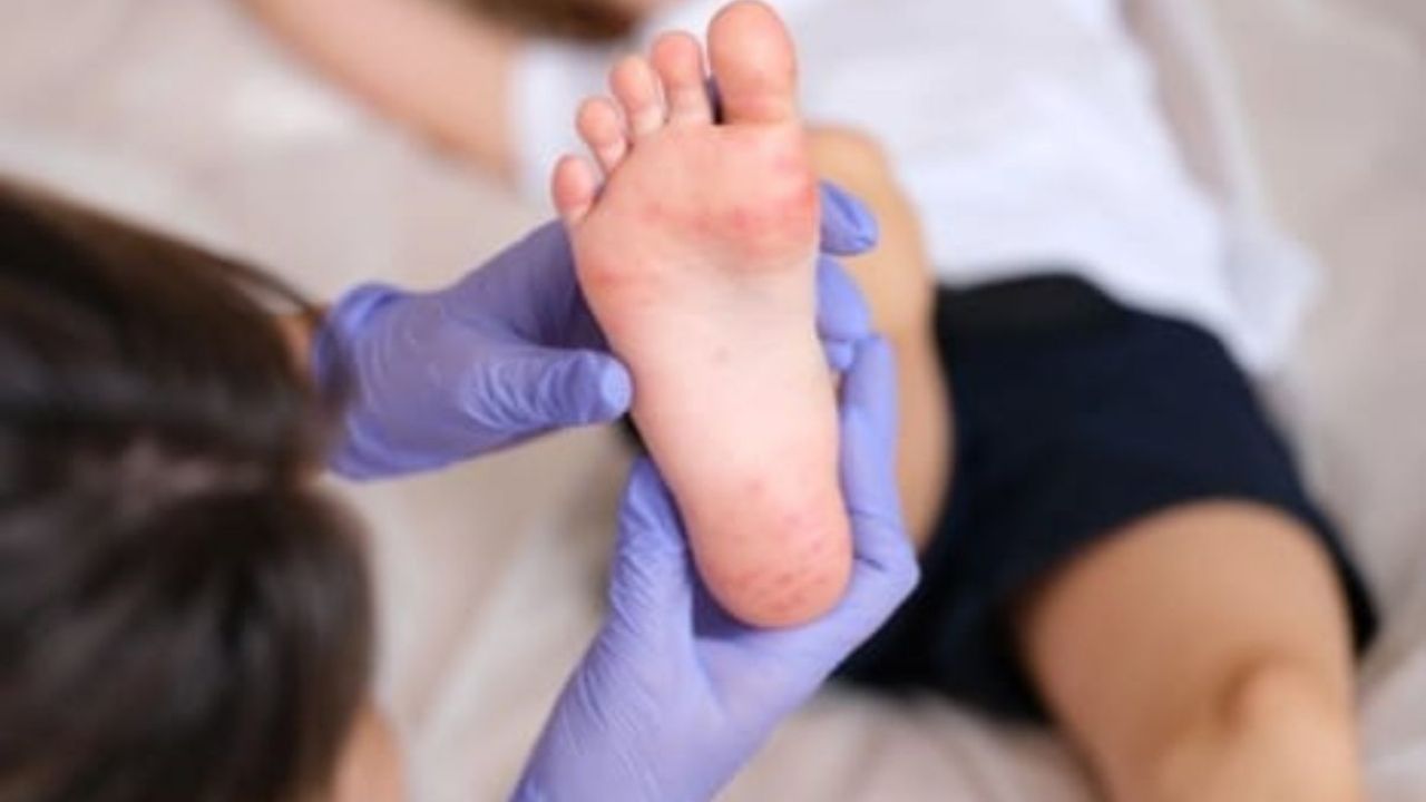 Alerta por virus Coxsackie en este estado: qué es y cómo se contagia