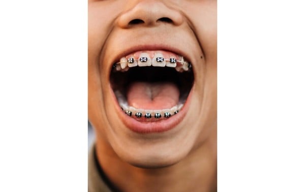 El regreso triunfal de los brackets