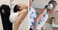 ‘Folded Boy’ Who Was Bent At 180 Degrees For Most Of His Life Stuns With ‘Magical’ Transformation