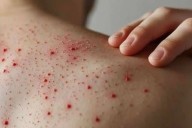 Pierde la vida otra menor indígena por sarampión