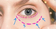 Why Lower Eyelid Plastic Surgery Is Trending Right Now